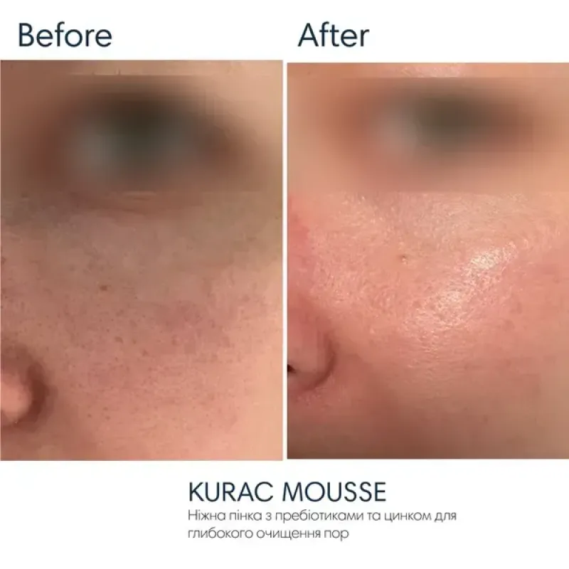 Делікатна пінка для вмивання BRADERM Kurac Mousse, 100 мл