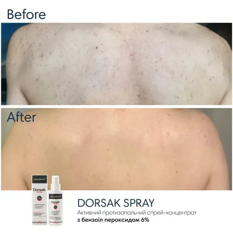 Протизапальний спрей-емульсія BRADERM Dorsak Spray, 100 мл
