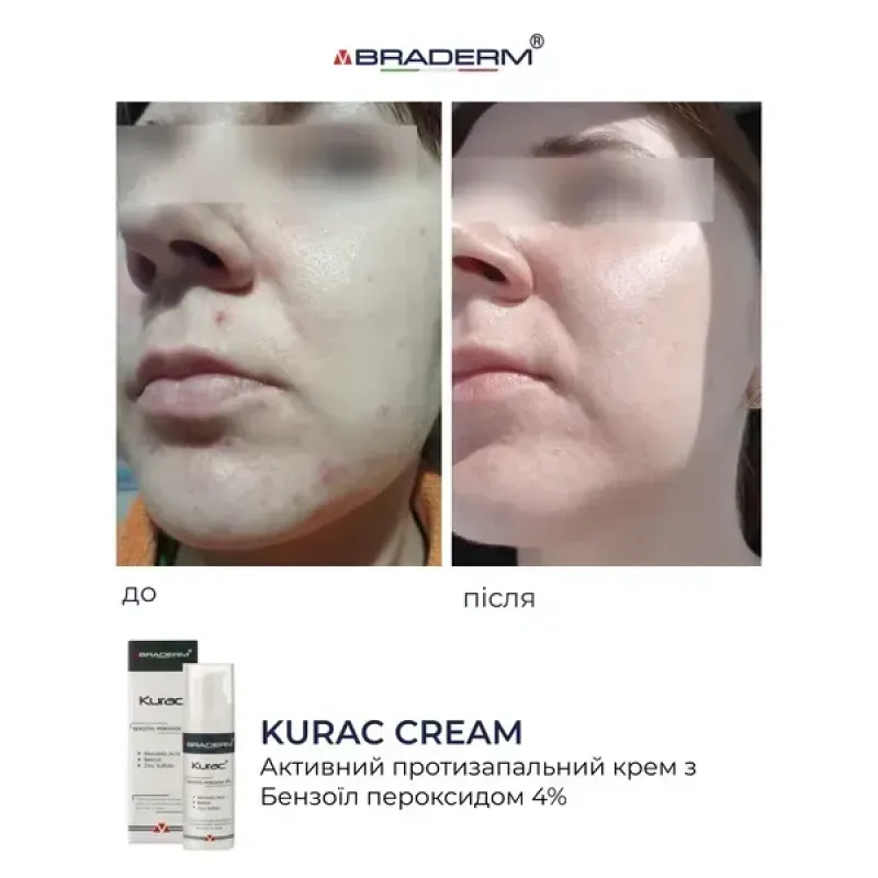Протизапальний крем BRADERM Kurac Cream, 30 мл