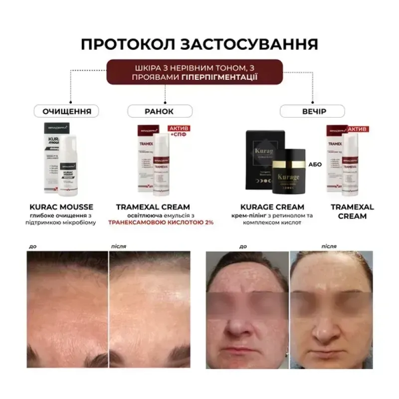 Освітлювальний крем BRADERM Tramexal Cream, 30 мл