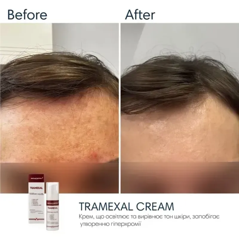Освітлювальний крем BRADERM Tramexal Cream, 30 мл