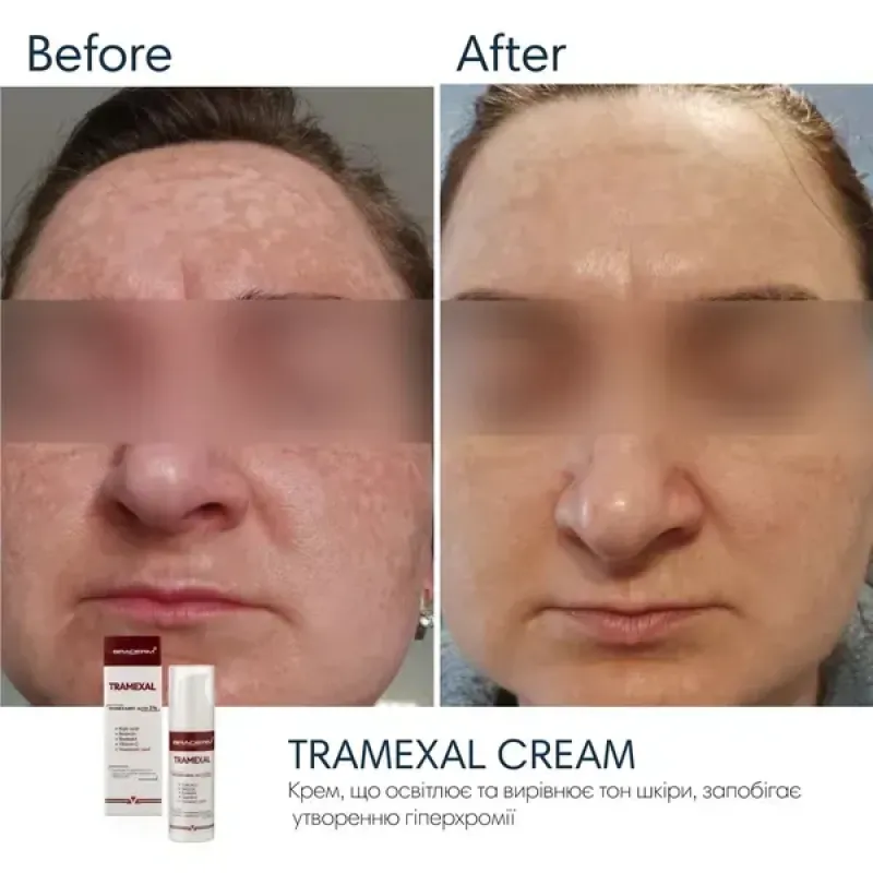 Освітлювальний крем BRADERM Tramexal Cream, 30 мл