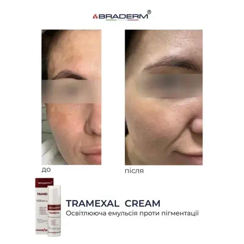 Освітлювальний крем BRADERM Tramexal Cream, 30 мл