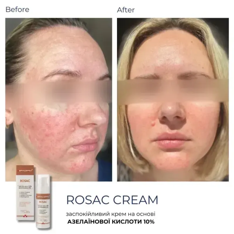 Заспокійливий крем BRADERM Rosac Cream, 30 мл