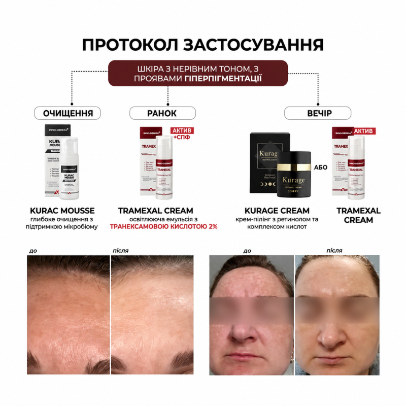 Освітлювальний крем BRADERM Tramexal Cream, 30 мл