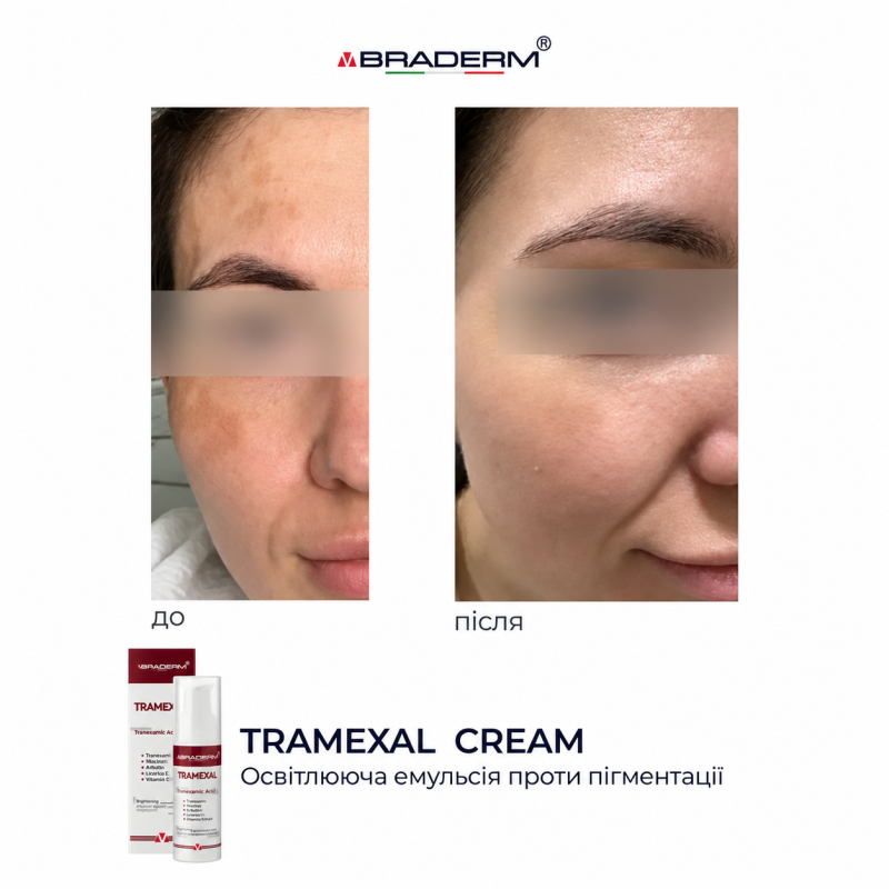 Освітлювальний крем BRADERM Tramexal Cream, 30 мл