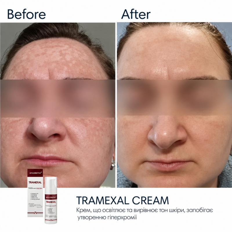 Освітлювальний крем BRADERM Tramexal Cream, 30 мл
