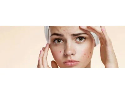 Чому не можна просто видавлювати прищі: ефективна профілактика та догляд за шкірою обличчя