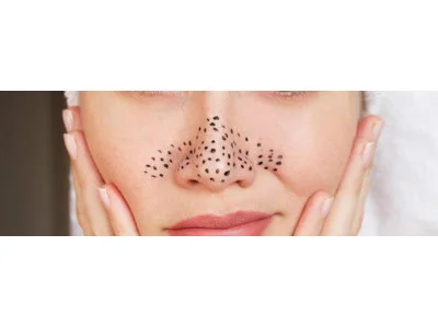 Как избавиться от черных точек на носу и на лице?